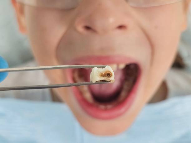 Best Emergency Dentist for Knocked-Out Tooth in Waverly, NY